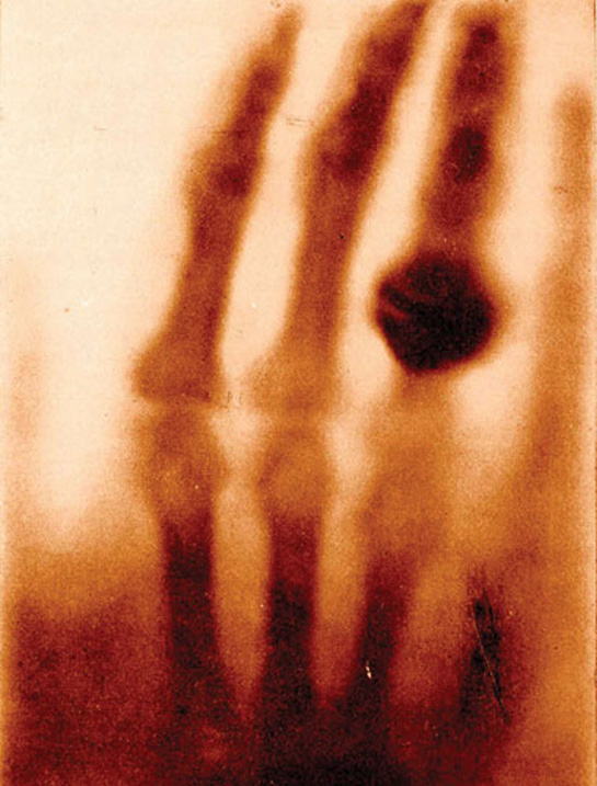 Image of X-ray hand of Mrs. Wilhelm Röntgen